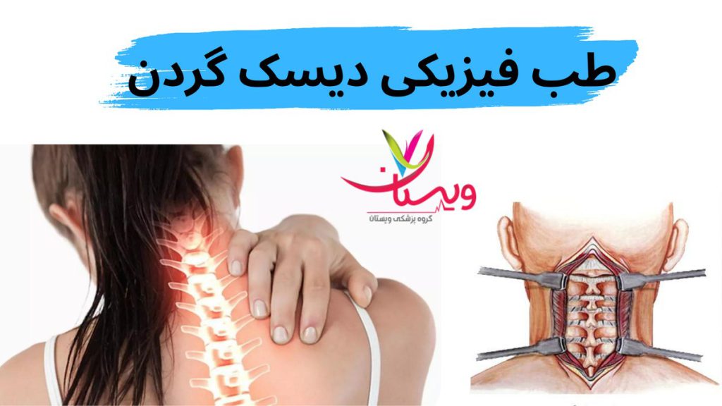 درمان فیزیکی دیسک گردن درمان دیسک گردن