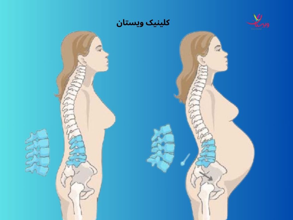 فشار بر ستون فقرات علت درد در ناحیه گودی کمر در بارداری