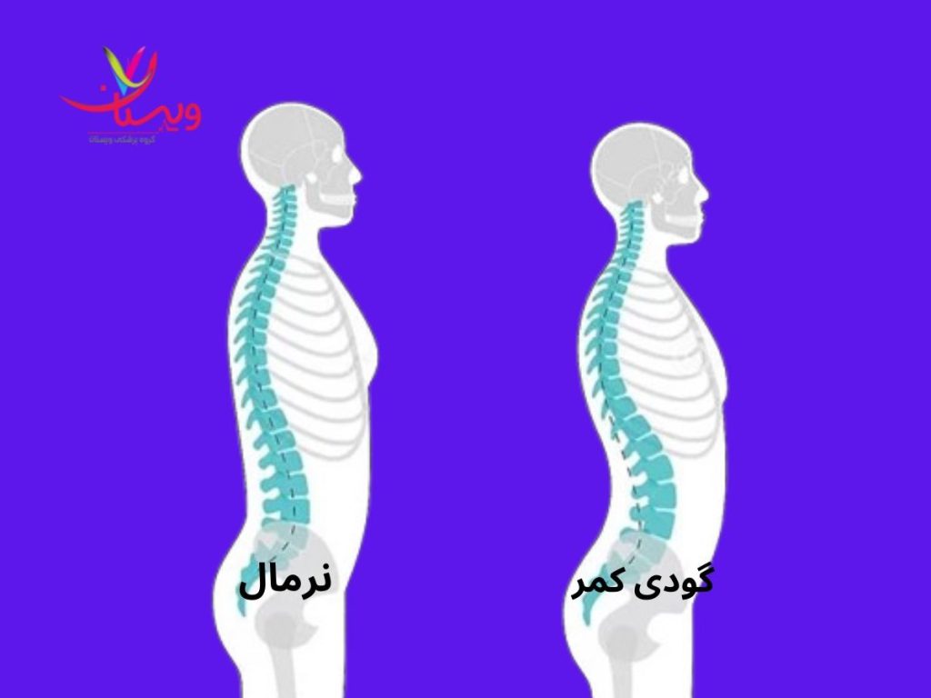 ضعف عضلات شکم و کمر علت درد گودی کمر هنگام ایستادن