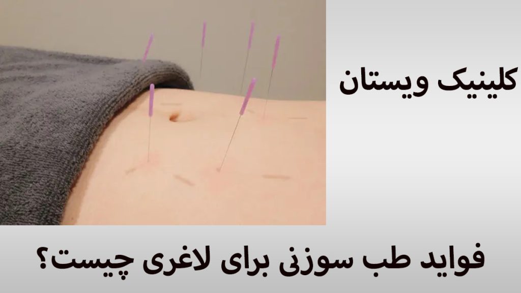 فواید طب سوزنی طب سوزنی برای شکم