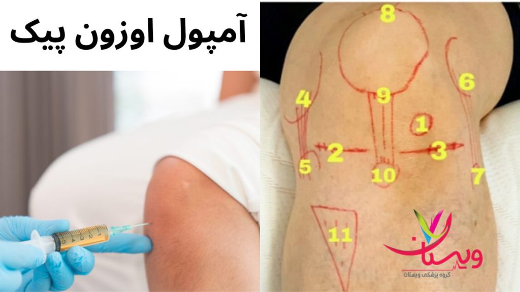 هزینه اوزون درمانی زانو قیمت آمپول اوزون پیک