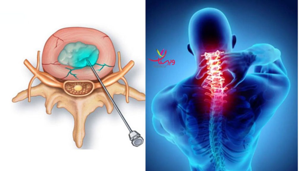 فیزیوتراپیست مراقبت های بعد از اوزون تراپی دیسک کمر