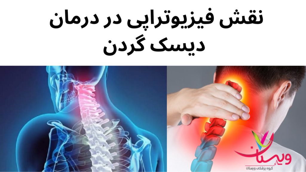 فیزیوتراپی برای دیسک گردن نقش فیزیوتراپی در درمان دیسک گردن