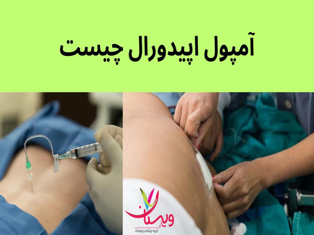 تزریق آمپول اپیدورال برای بیمار مبتلا به کمردرد آمپول اپیدورال چیست
