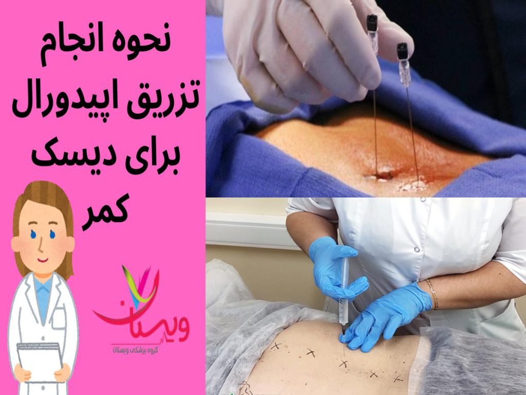 انجام تزریق اپیدورال برای کمردرد نحوه انجام تزریق اپیدورال برای دیسک کمر