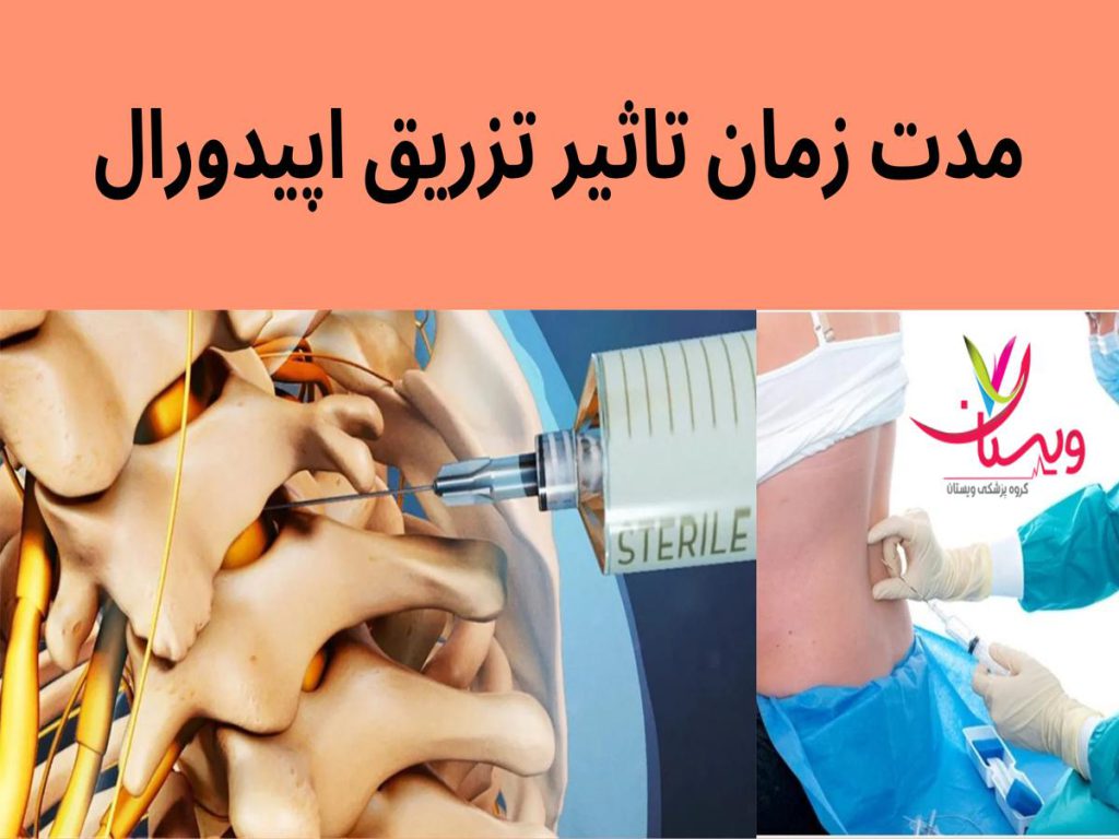 بازه زمانی تاثیر تزریق اپیدورال مدت زمان تاثیر تزریق اپیدورال