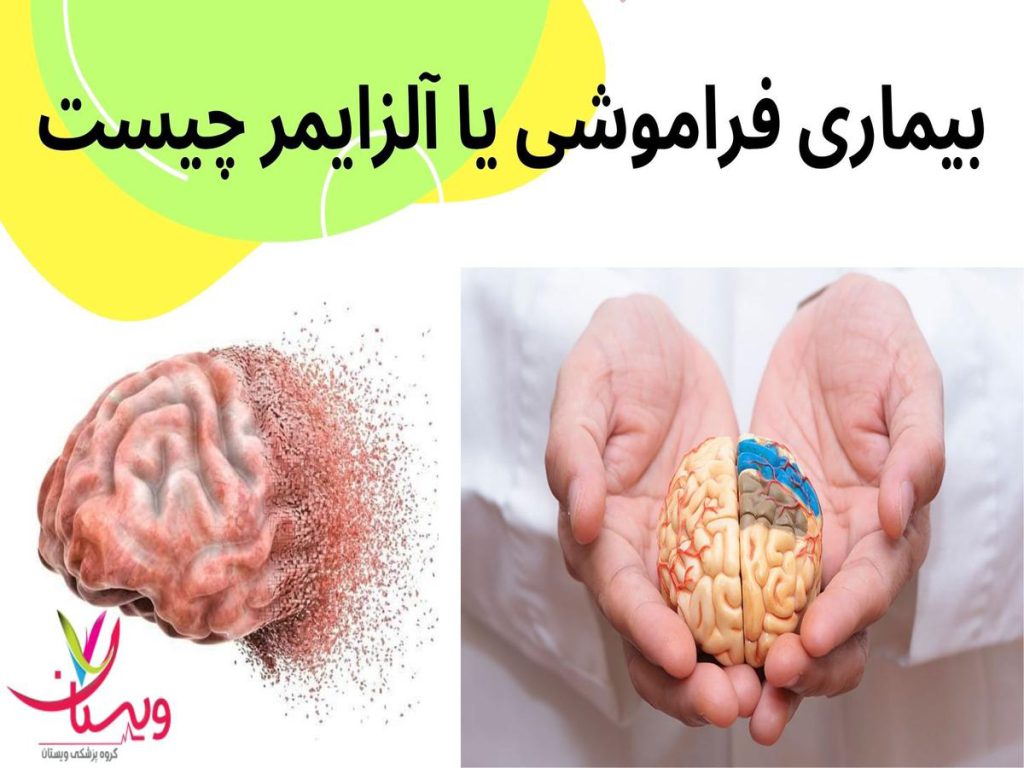 کاهش تدریجی حافظه در آلزایمر بیماری فراموشی