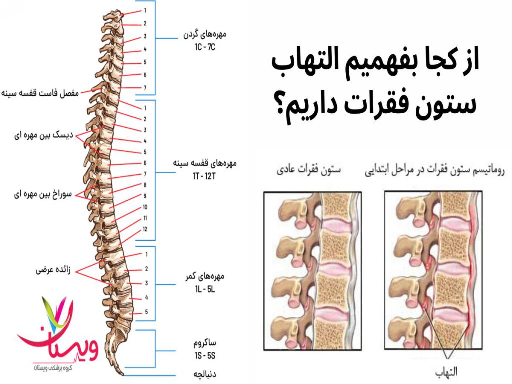 تشخیص التهاب ستون فقرات از کجا بفهمیم التهاب ستون فقرات داریم