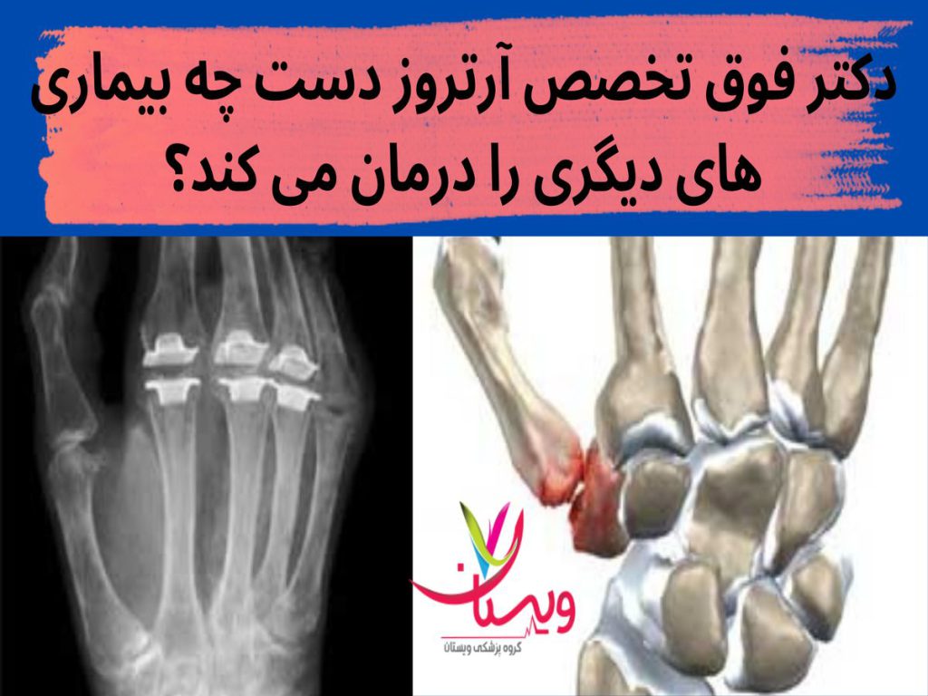 فوق تخصص آرتروز دست دکتر فوق تخصص آرتروز دست چه بیماری های دیگری را درمان می کند