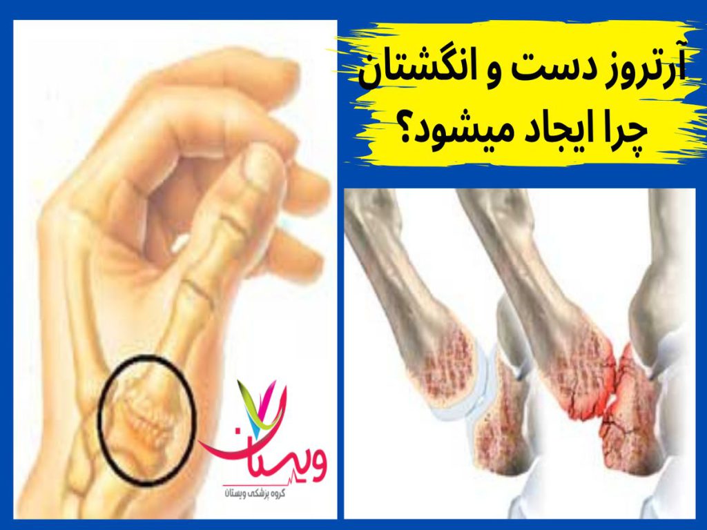 آرتروز دست و انگشتان آرتروز دست و انگشتان چرا ایجاد میشود