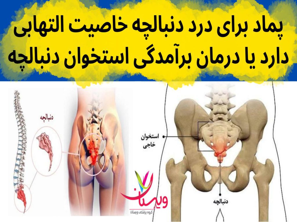 پماد برای درمان درد دنبالچه پماد برای درد دنبالچه خاصیت التهابی دارد یا درمان برآمدگی استخوان دنبالچه