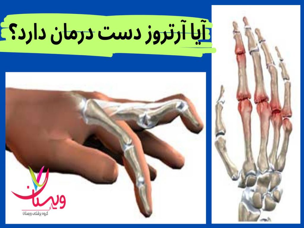 آرتروز دست آیا آرتروز دست درمان دارد
