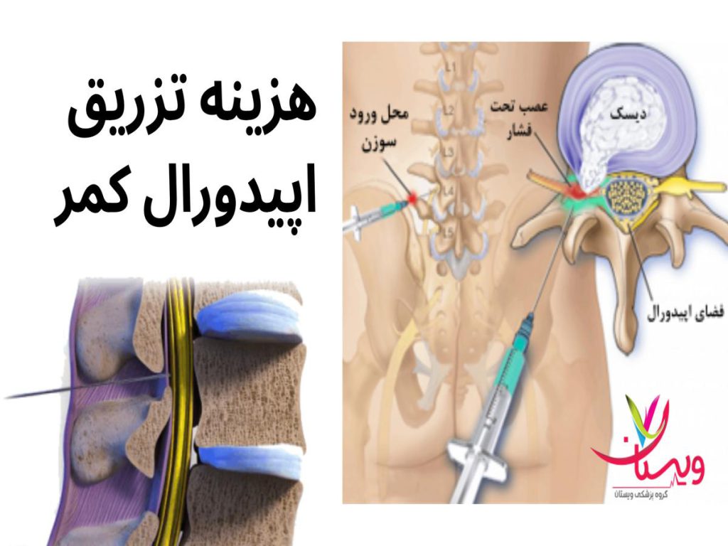 آمپول اپیدورال برای تنگی کانال نخاعی قیمت آمپول اپیدورال کمر