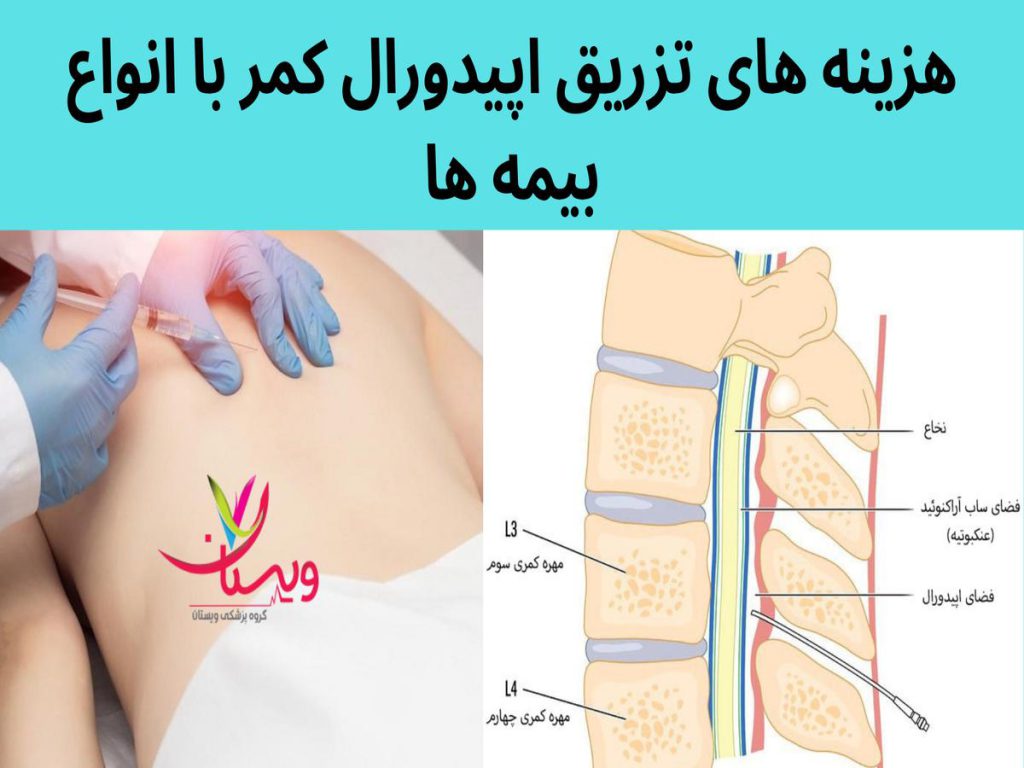 تزریق اپیدورال با بیمه های مختلف هزینه های تزریق اپیدورال کمر با بیمه