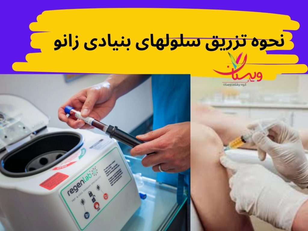 تزریق به ناحیه آسیبدیده زانو نحوه تزریق سلولهای بنیادی زانو