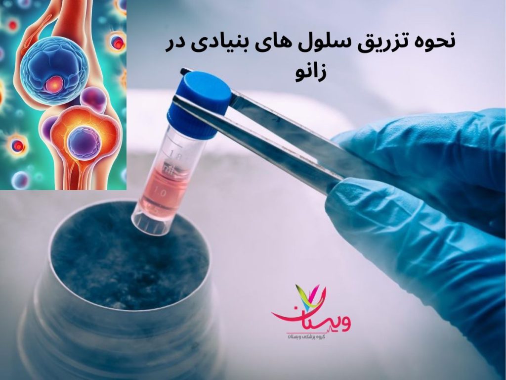 تزریق کردن سلول بنیادی زانو نحوه تزریق سلول های بنیادی در زانو