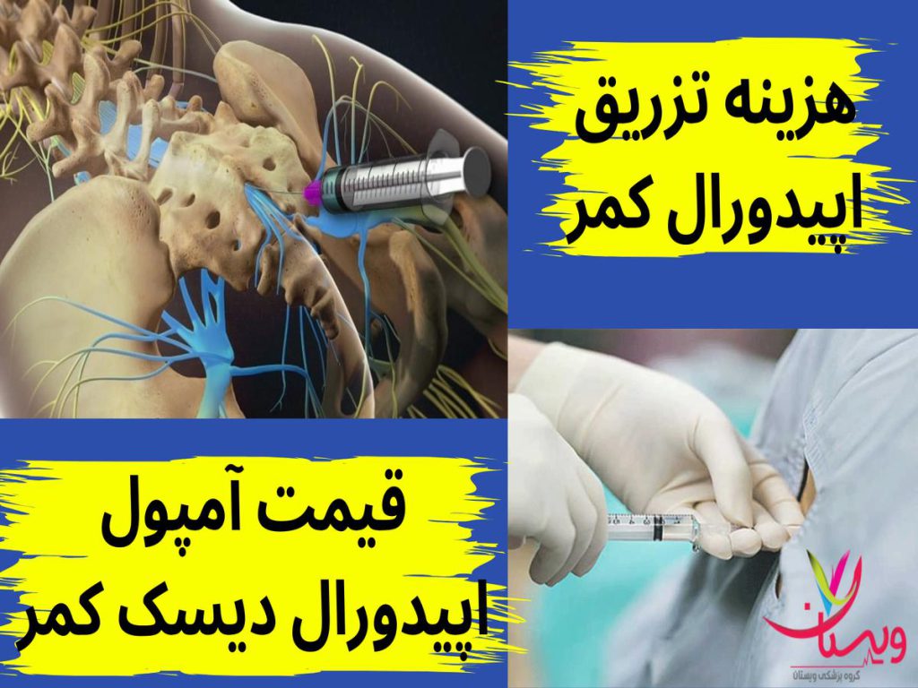 هزینه تزریق اپیدورال کمر