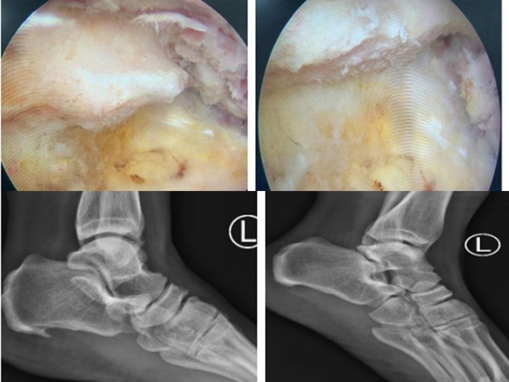 انواع جراحیها برای درمان خار پاشنه