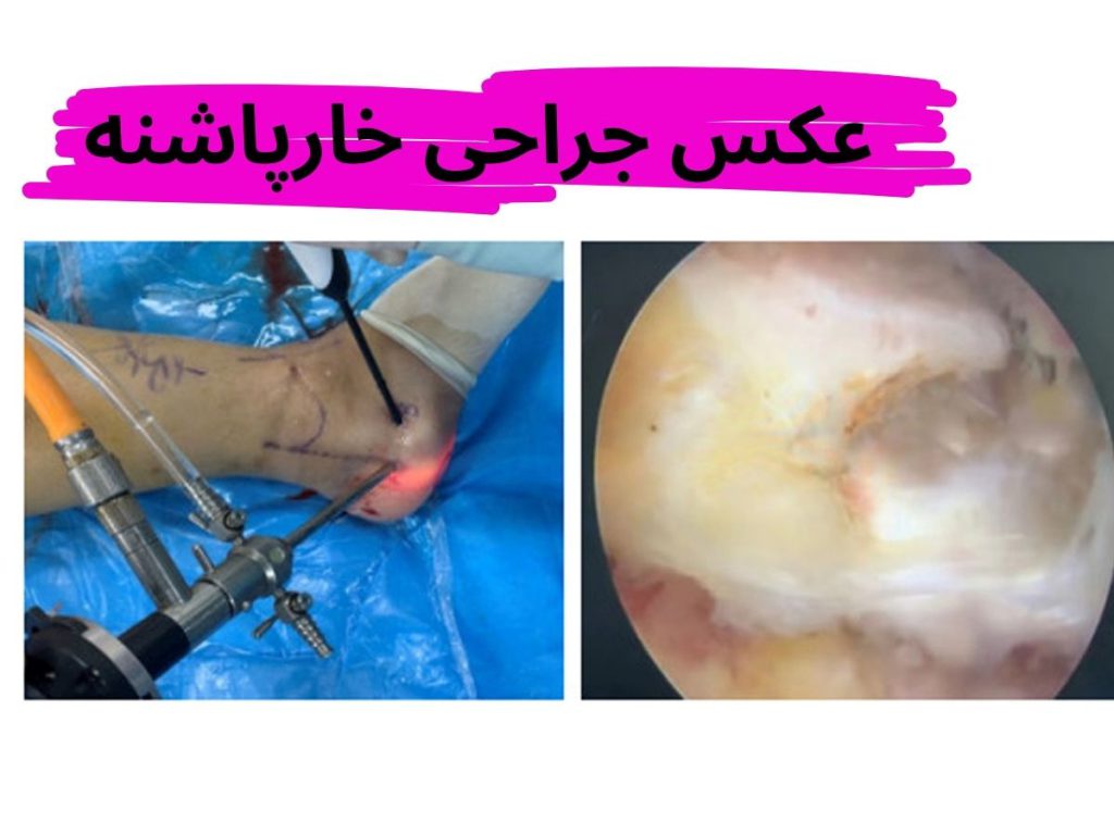 عکس جراحی خارپاشنه