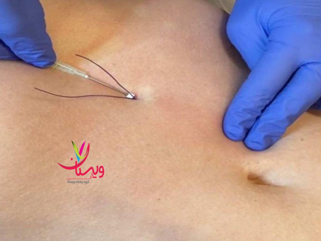 نخ انداختن نخ لاغری