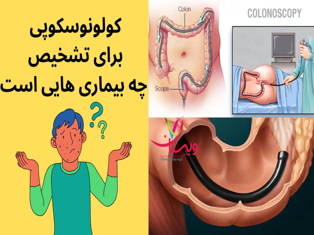 سرطان روده کولونوسکوپی برای تشخیص چه بیماری هایی است