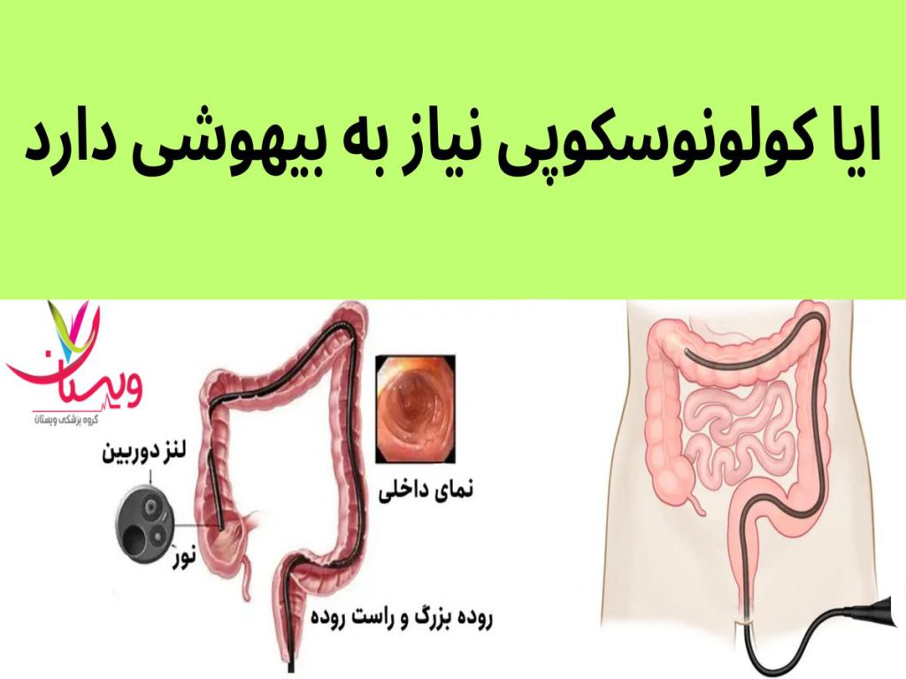 عمل کولونوسکوپی ایا کولونوسکوپی نیاز به بیهوشی دارد