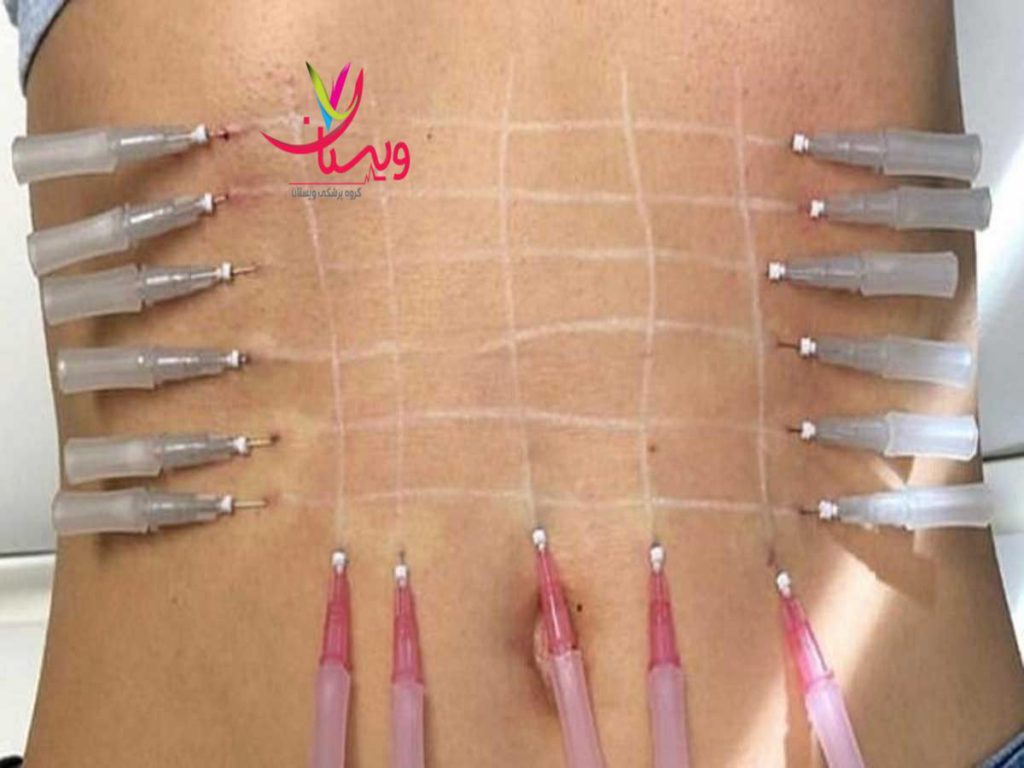 چربیهای موضعی نخ انداختن برای لاغری شکم