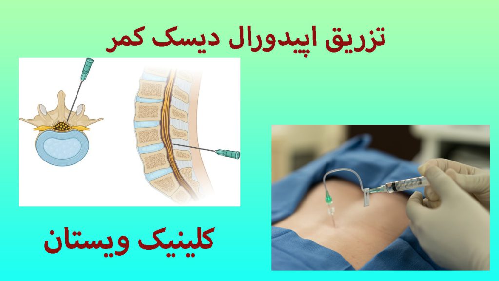 تزریق اپیدورال اپیدورال برای دیسک کمر