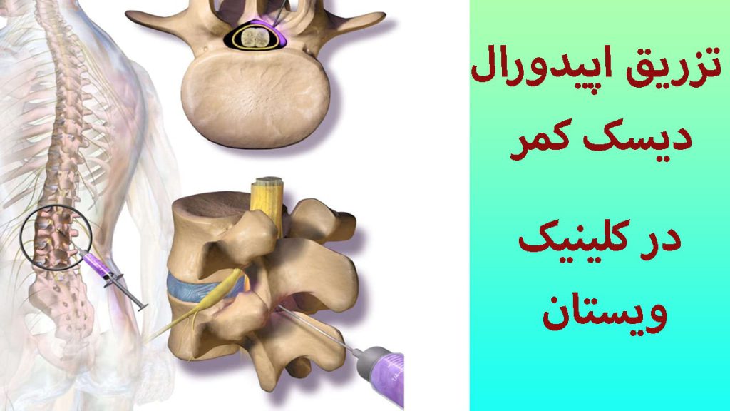 تزریق اپیدورال به مهره های کمر بیمار انجام می شود