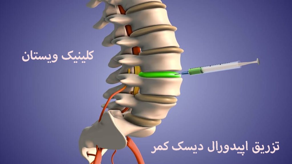 تزریق اپیدورال دیسک کمر تزریق به مهره های کمر-تصویر دیجیتالی است