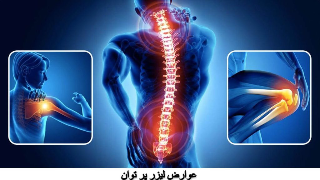 عوارض لیزر پر توان/ دیسک کمر و درد مفاصل عوارض لیزر پر توان/ دیسک کمر و درد مفاصل
