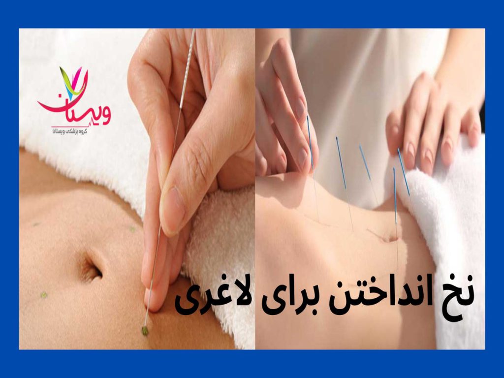 کاهش وزن عوارض نخ انداختن شکم برای لاغری
