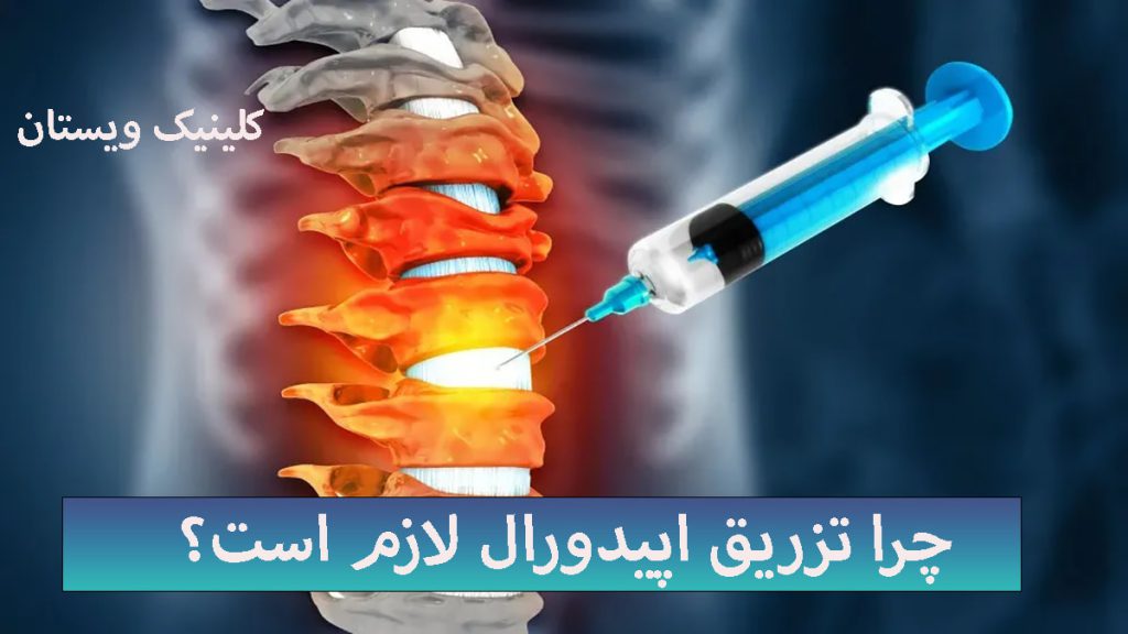 تزریق اپیدورال تصویری دیجیتالی از تزریق اپیدورال به کمر