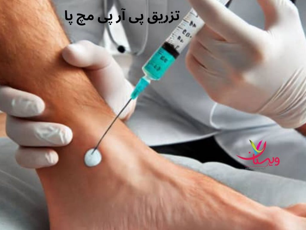 ناحیه تزریق prp تزریق پی آر پی مچ پا