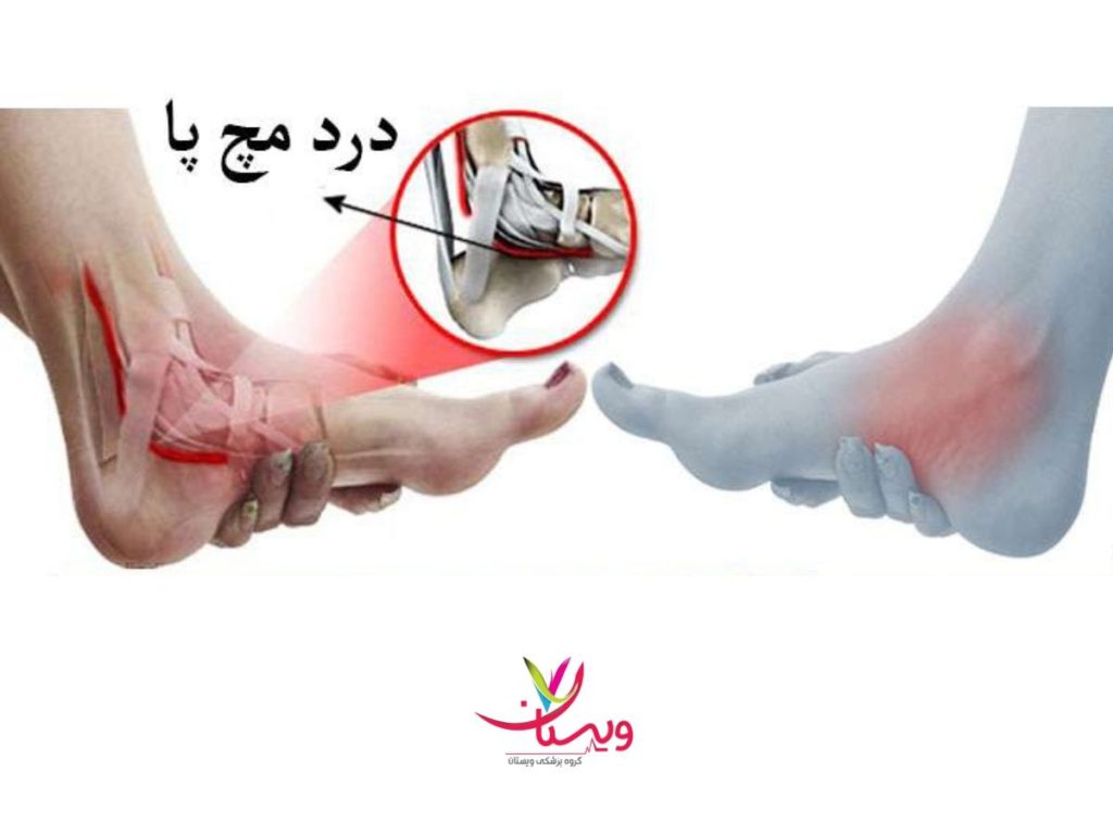 درد ناحیه مچ پا بیماریهای رایج مچ پا برای درمان با پی آر پی