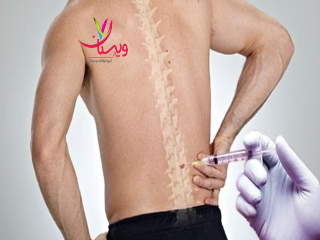 درد کمر نظرات مردم در مورد پی ار پی کمر