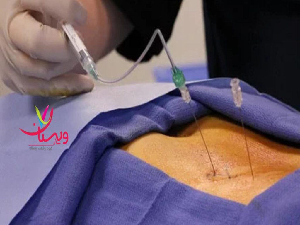 تزریق کورتون تزریق کورتون به دنبالچه چطور انجام می شود