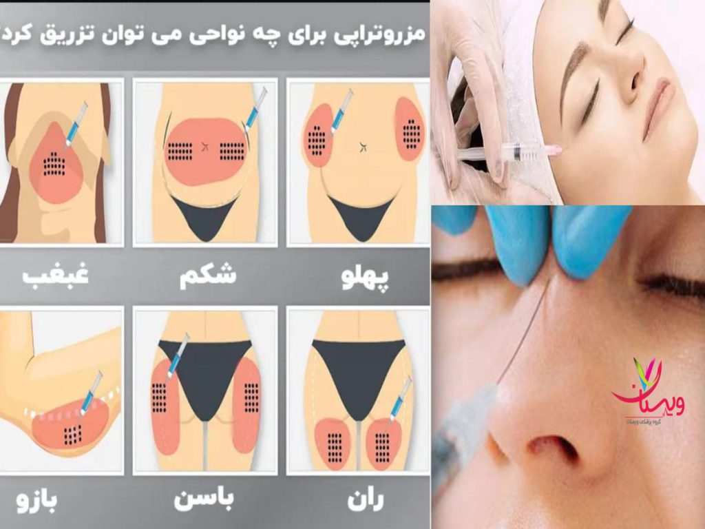 چربیهای موضعی نحوه تزریق کوکتل لاغری