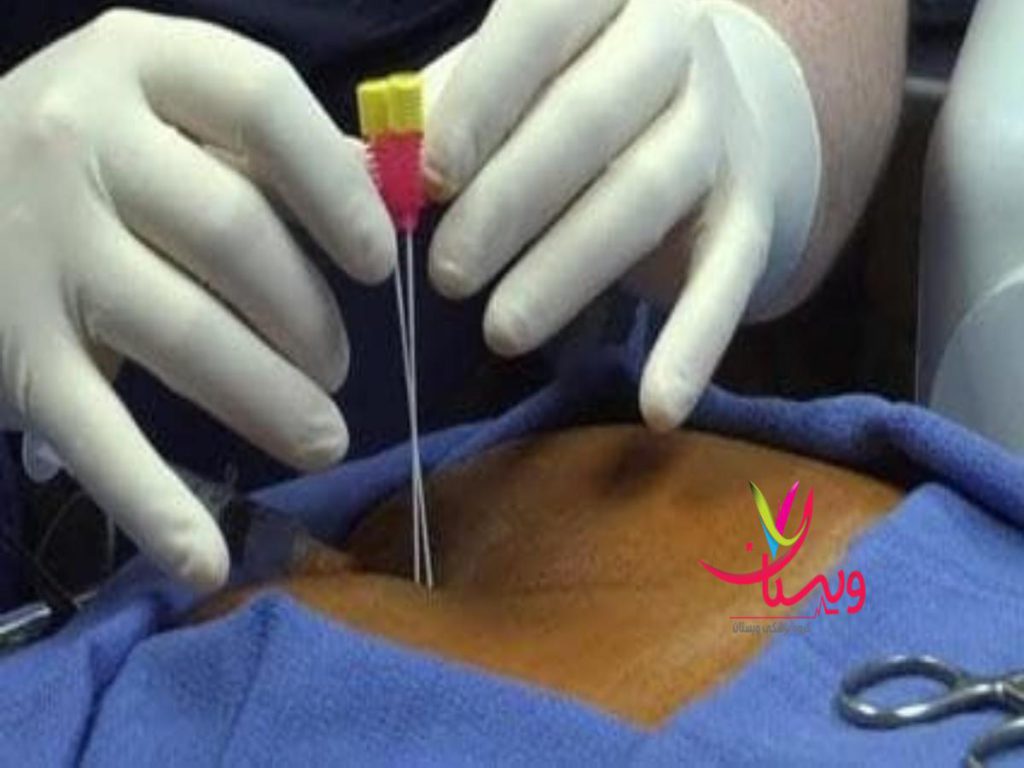 دنبالچه نکات لازم پس از تزریق برای کاهش عوارض احتمالی تزریق