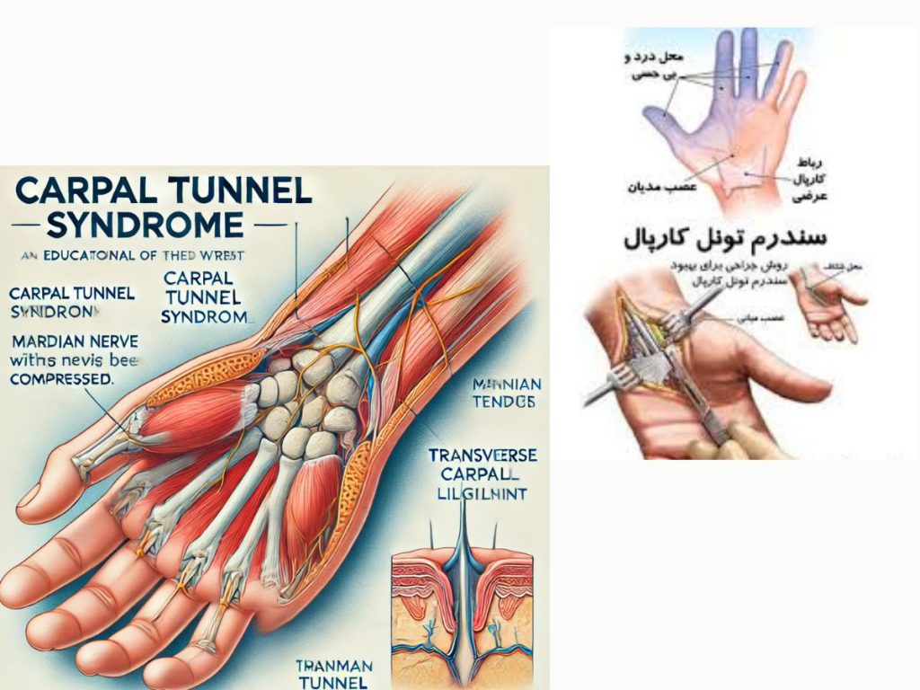 اختلال عصبی درمان قطعی سندروم تونل کارپال