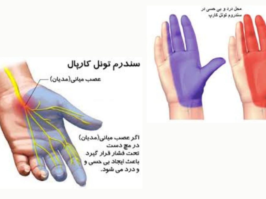 مچ دست عصب تونل کارپال