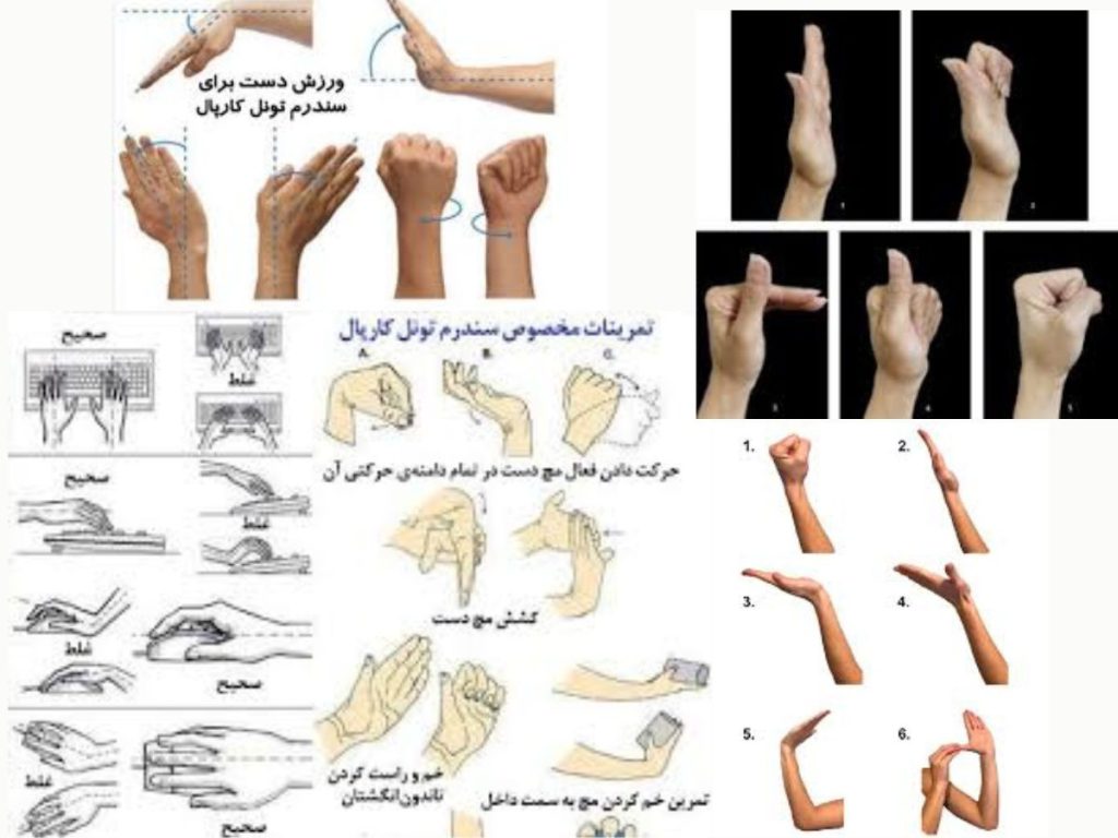 تسکین درد فیزیوتراپی سندروم تونل کارپال
