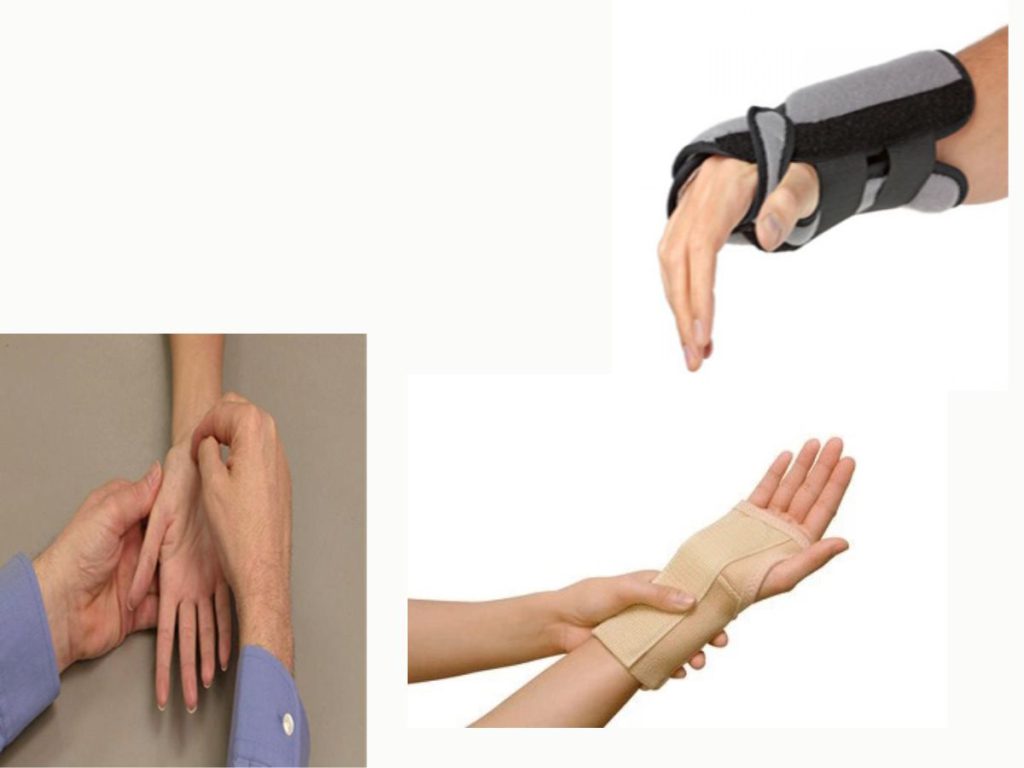 محدود کردن حرکت مچ دست مچ بند سندروم تونل کارپال درمان قطعی می باشد