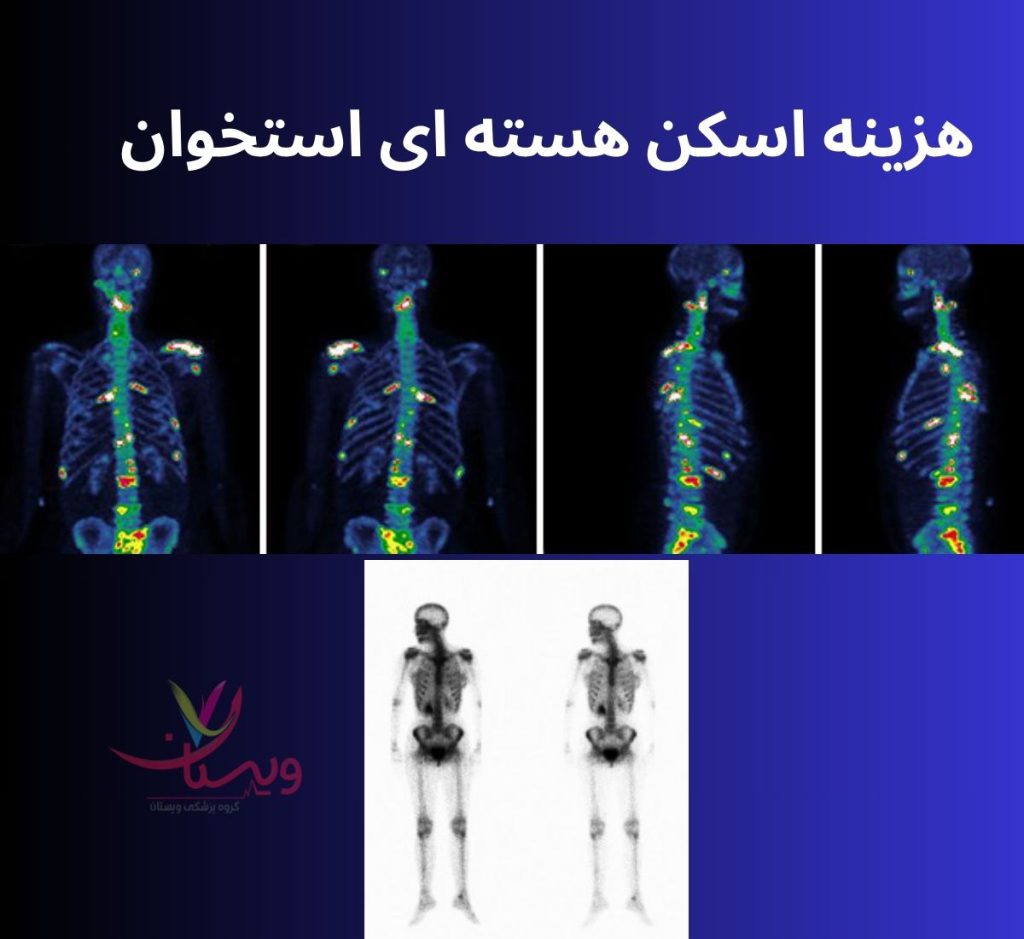 هزینه اسکن هسته ای استخوان