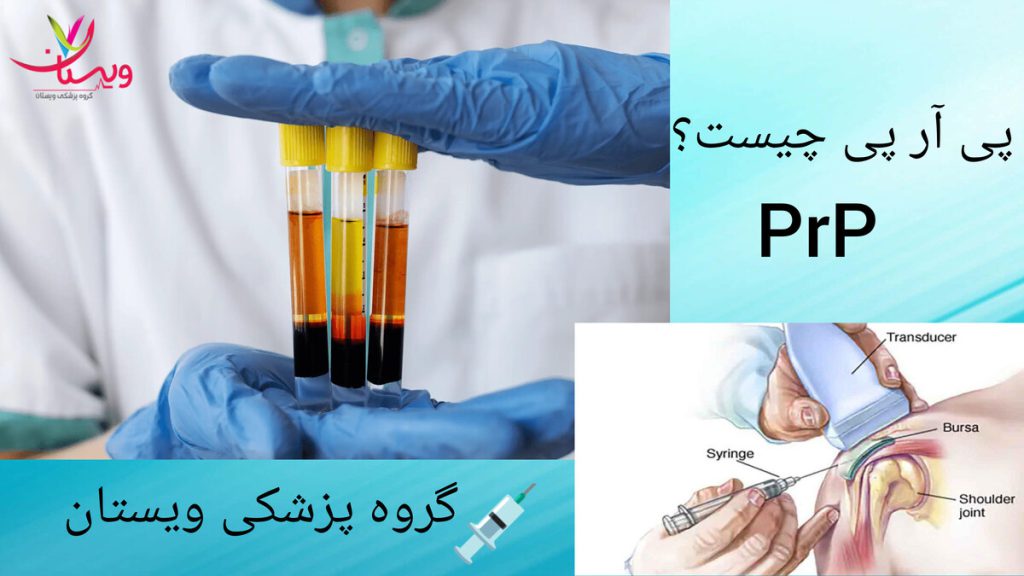 استفاده از پی آر پی در درمان مشکلات شانه نمونه ای از پلاسمای غنی شده در دستان پزشک