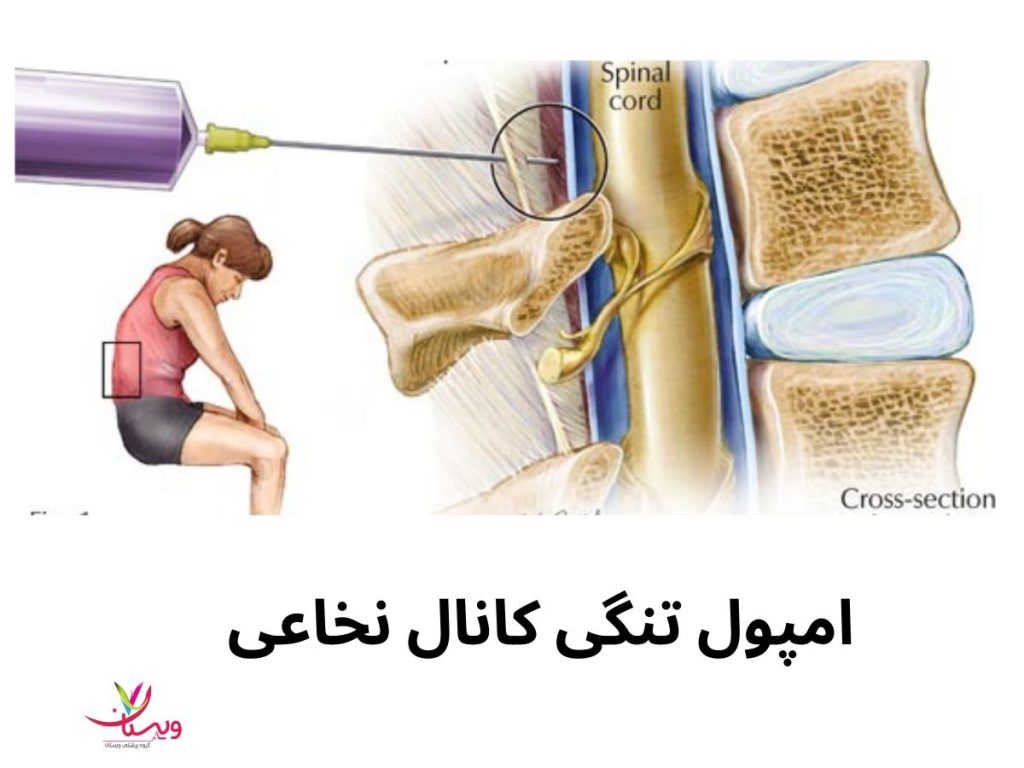 آمپول تنگی کانال نخاعی