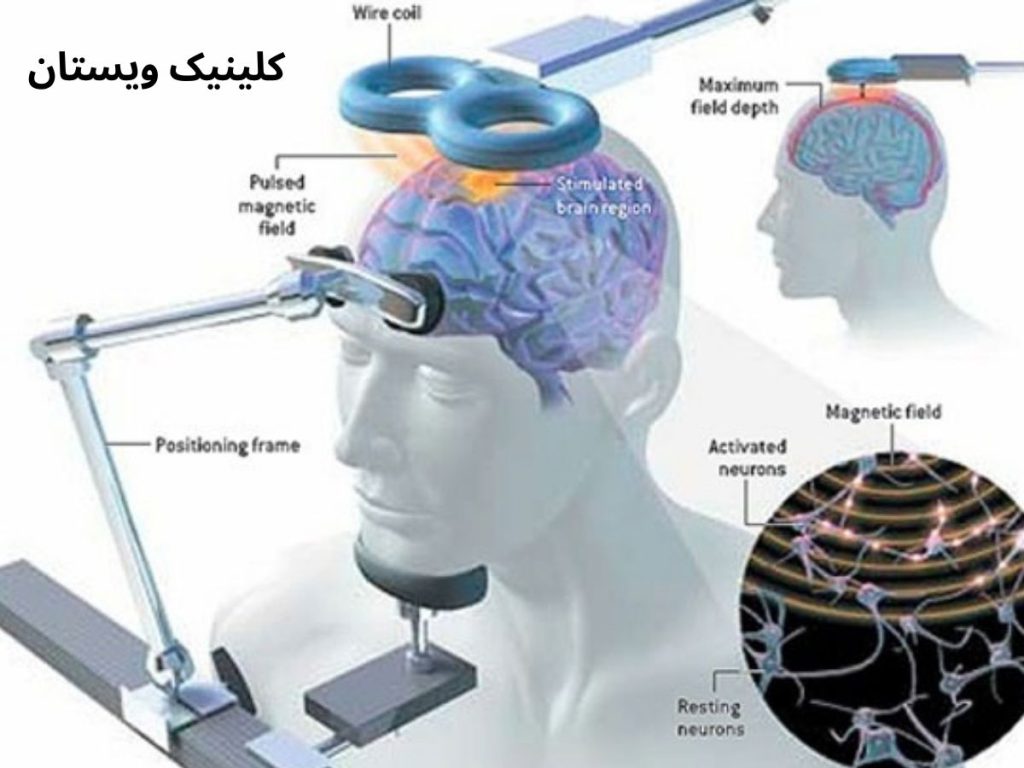 تحریک مغناطیسی مکرر ترانسکرانیال rtms آر تی ام اس برای چه افرادی مناسب است؟