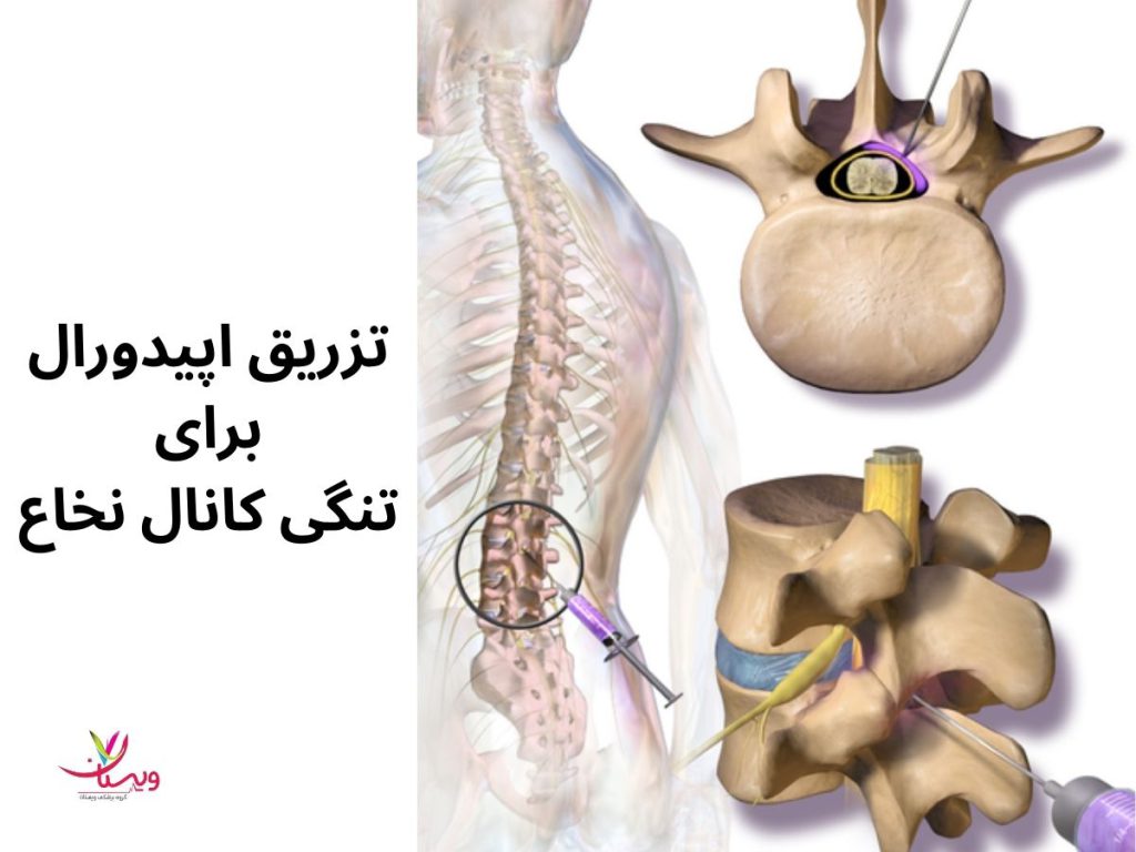 تزریق داخل مهره کمر تزریق اپیدورال برای تنگی کانال نخاع
