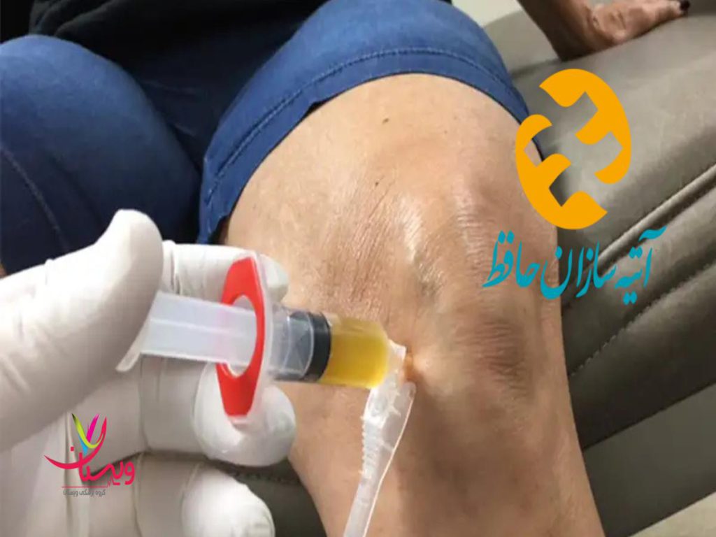 بیمه اتیه سازان حافظ هزینه اگزوزوم تراپی زانو بیمه اتیه سازان حافظ