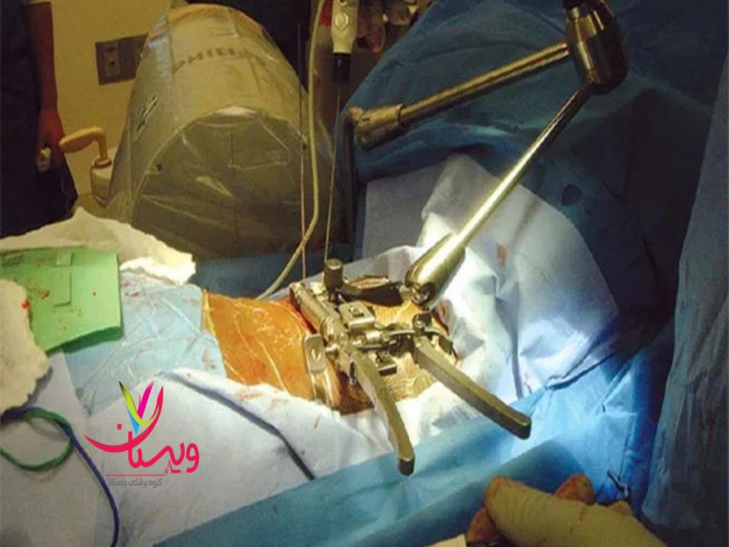دیسک کمر با لیزر هزینه عمل دیسک کمر با لیزر